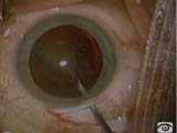 Pars plana vitreous aspiration