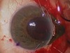 Oettrogenic Hyphema and Iridodialysis