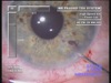Easy Iridectomy
