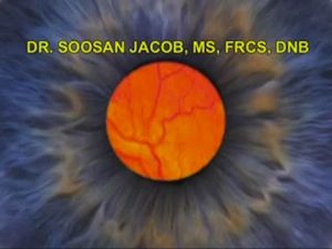 Iris IOL Scaffold with Sub Flap Vitrectomy