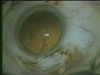 New Needle for Scleral Fixation