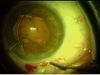 Y Spatula-Assisted Bimanual Implantation of Capsular Tension Ring