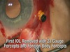  Removal of Dislocated Posterior Chamber Intraocular Lenses Through Scleral Incision