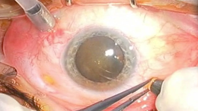 Traction Retinal Detachments