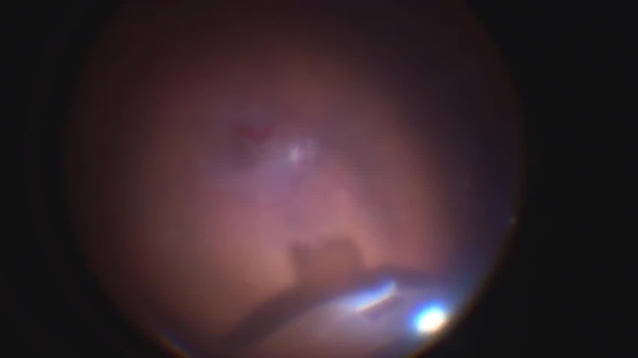 Autotransplantation of Retinal Graft in Treatment of Large Macular Hole