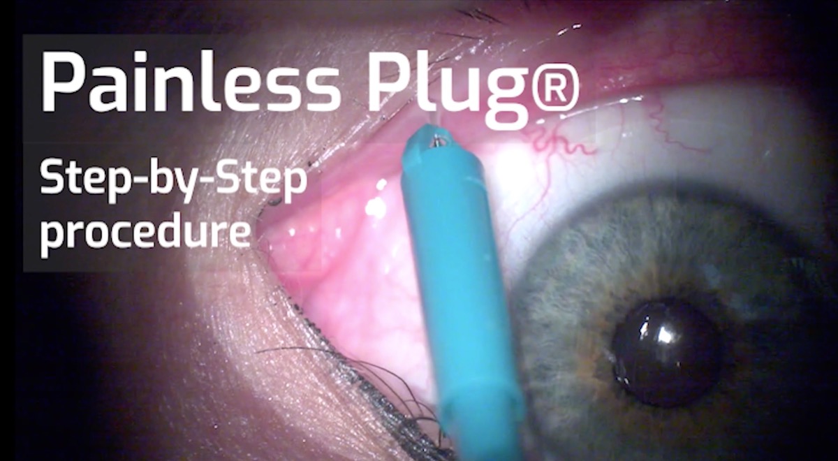 Painless Plug<sup>®</sup> | International | Permanent Punctum Plug | Step-by-step Procedure
