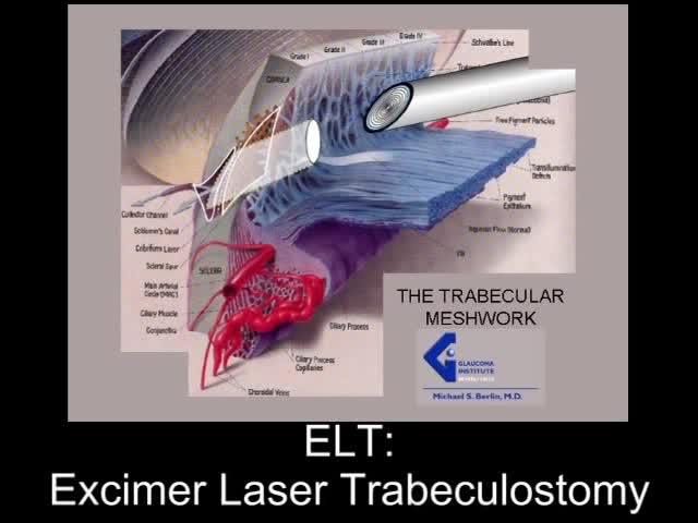 Excimer Laser Trabeculostomy (ELT)