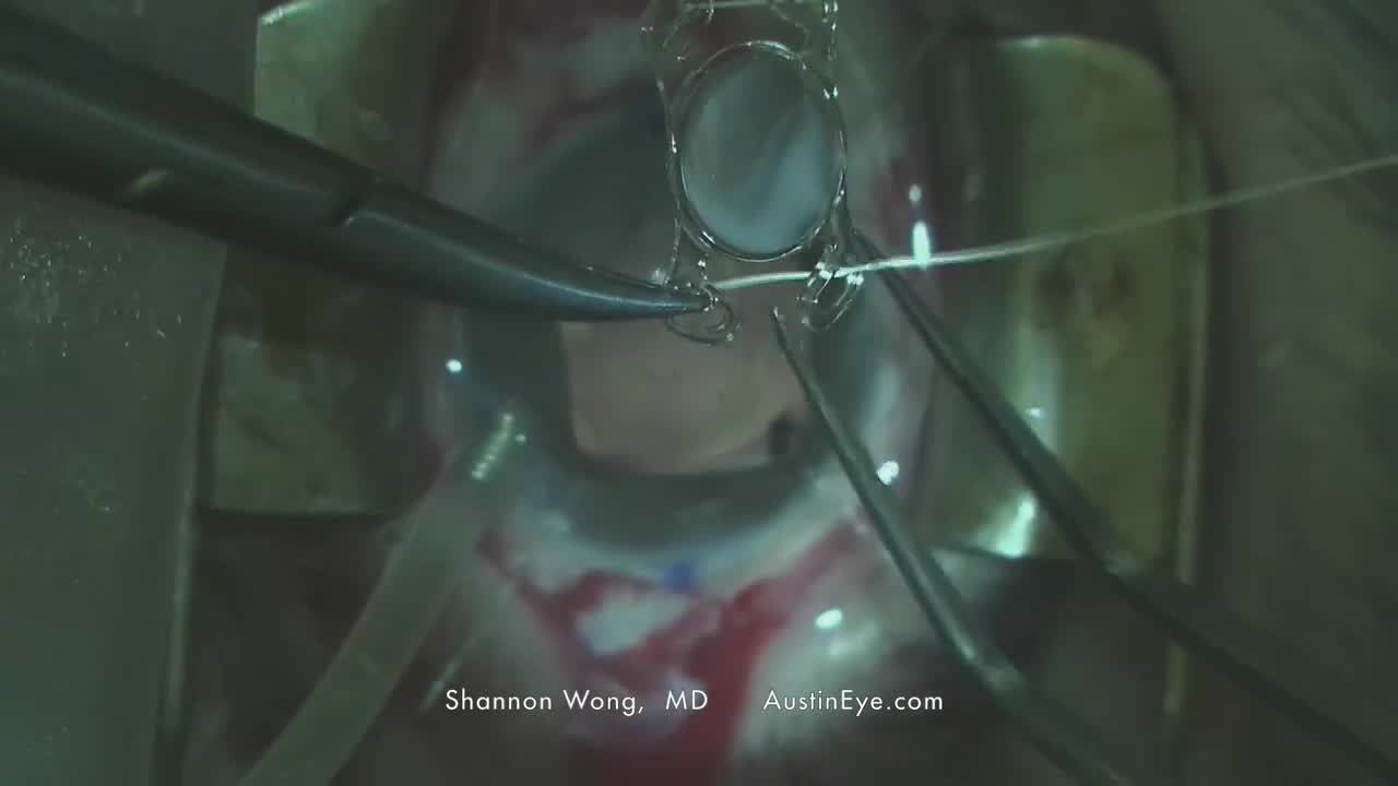 Akreos Scleral Fixation with Goretex