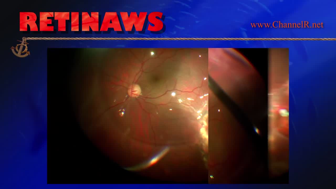 Recurrent Retinal Detachment