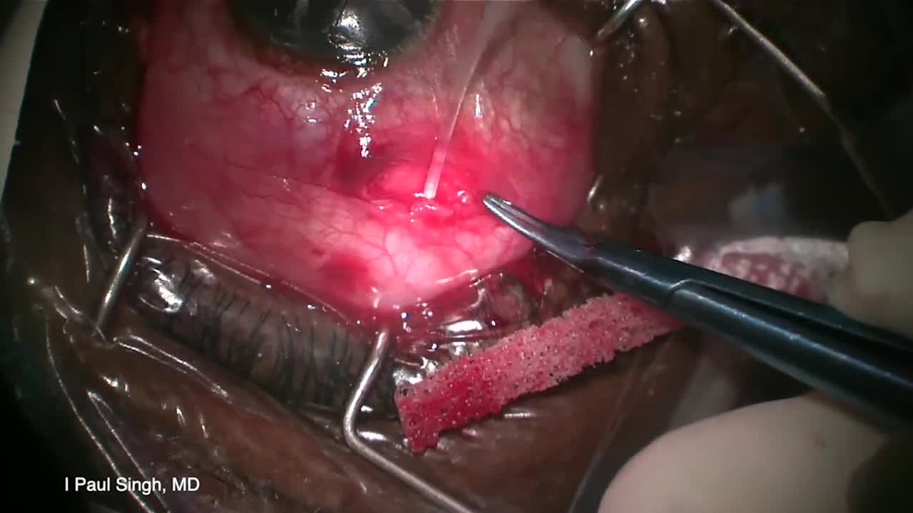 ClearPath Glaucoma Drainage Device: Small Incision Approach