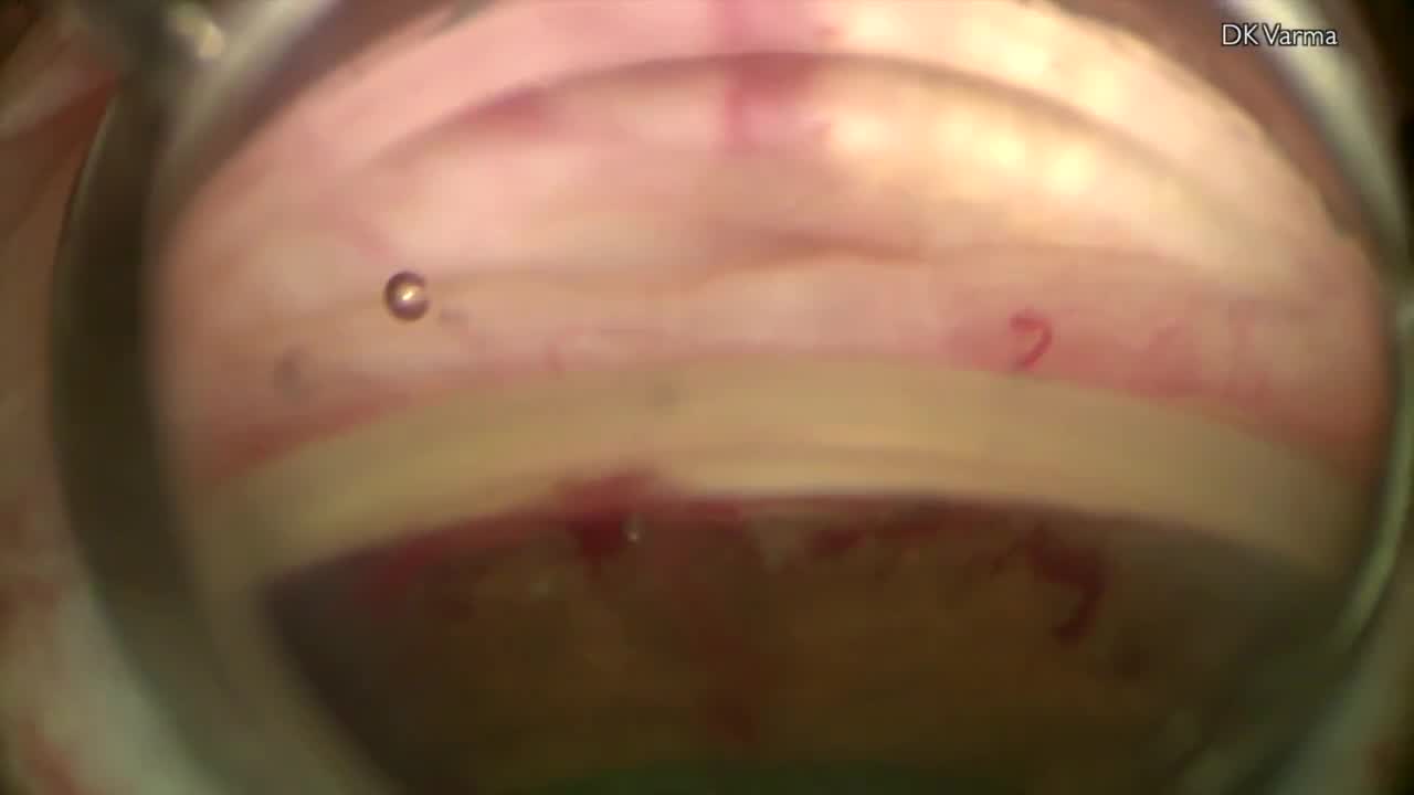 Targeted iStent implantation