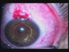 Phakic Lens and Ferrara Ring in Keratoconic Patient