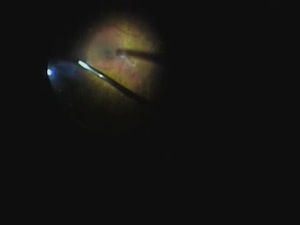 25G Vitrectomy for the Treatment of Chronic Vitreous Hemorrhage In a Patient With Iris Coloboma
