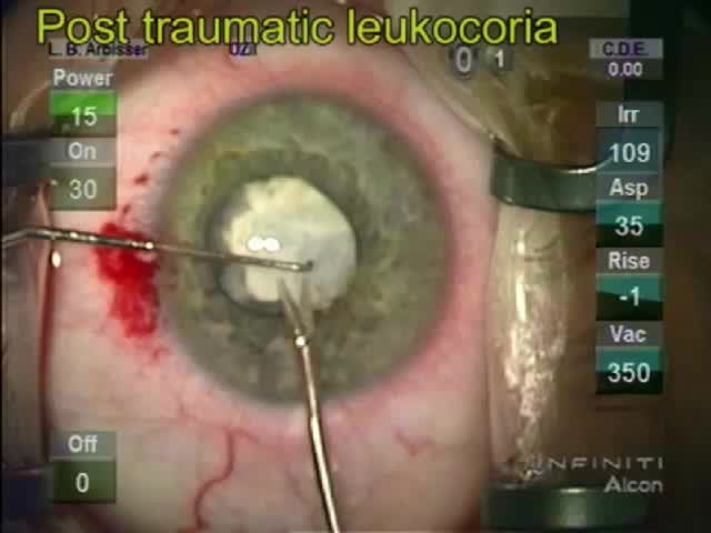 Post Traumatic Leukocoria