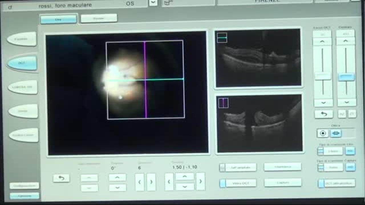Macular Hole Surgery [FLOREtina Live Surgery]