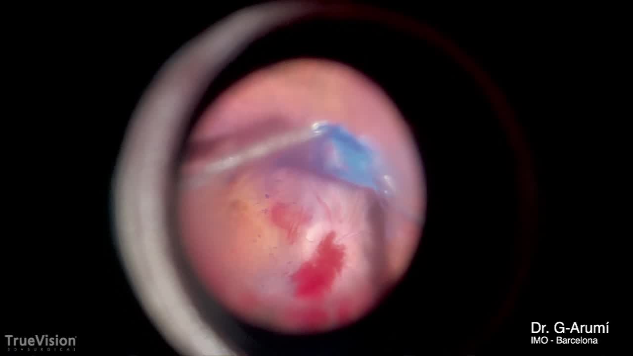 Macular Schisis