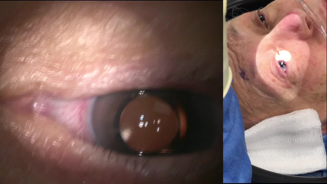 Dextenza Insertion: Split View