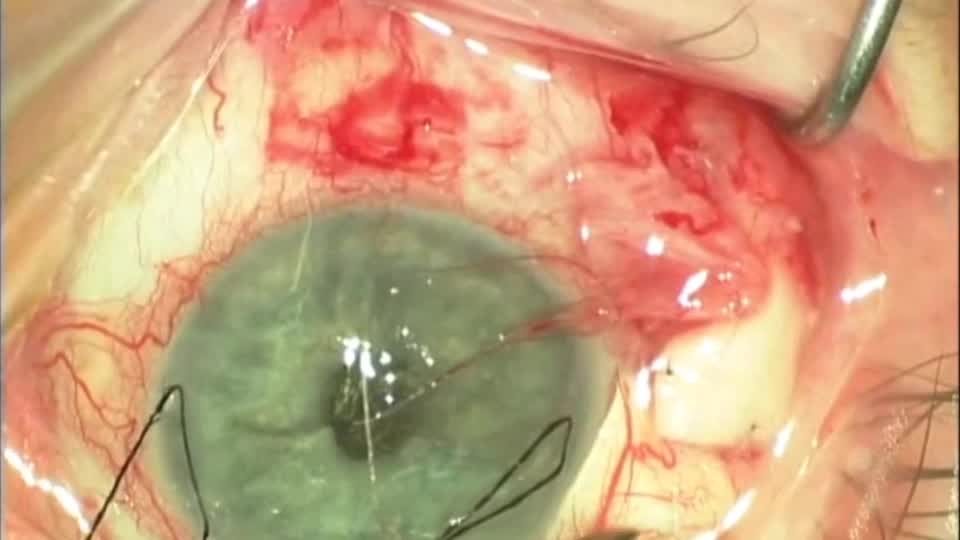 A Novel Surgical Technique For Closure of Dehiscence Conjunctiva Due to Glaucoma Drainage Device