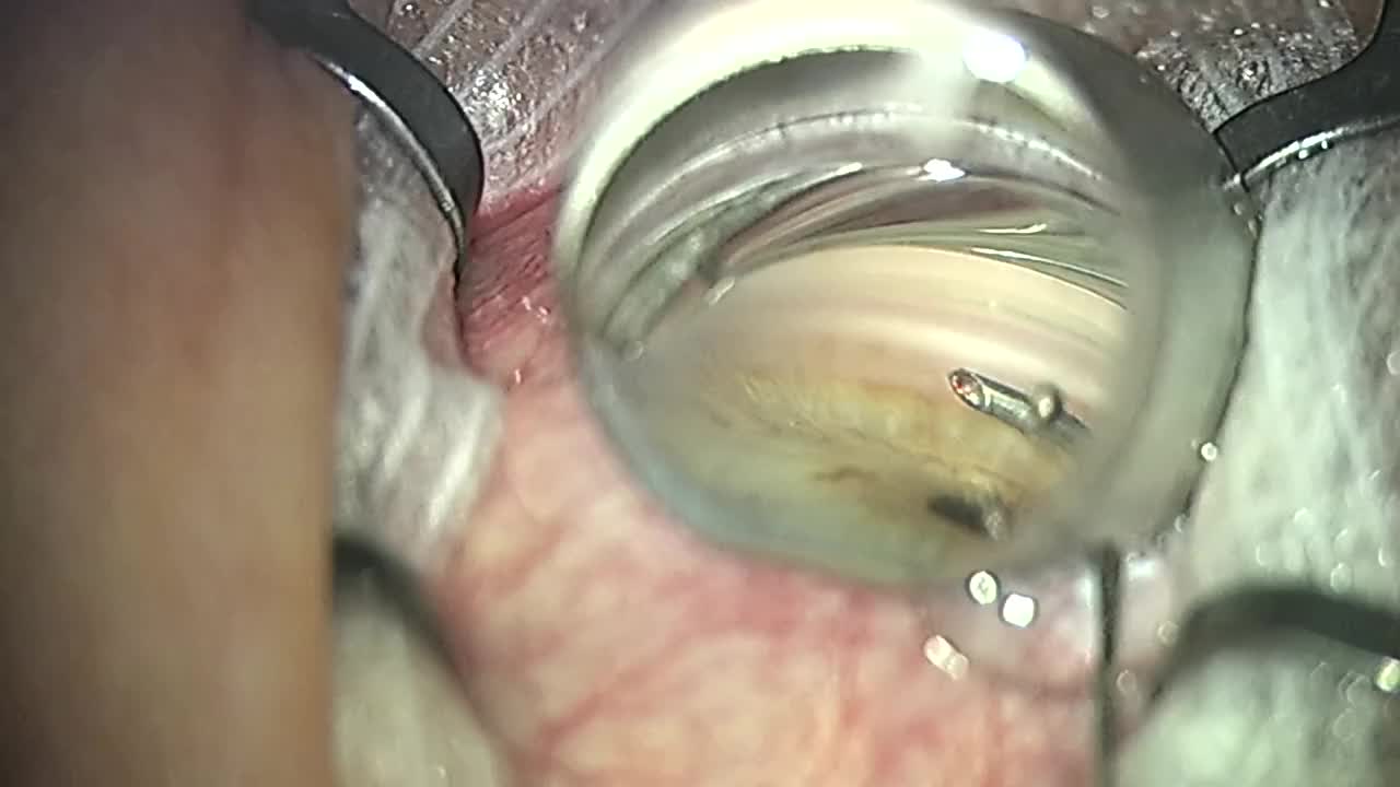 Ab Interno 360 degree Trabeculotomy Using the Trab360 Device