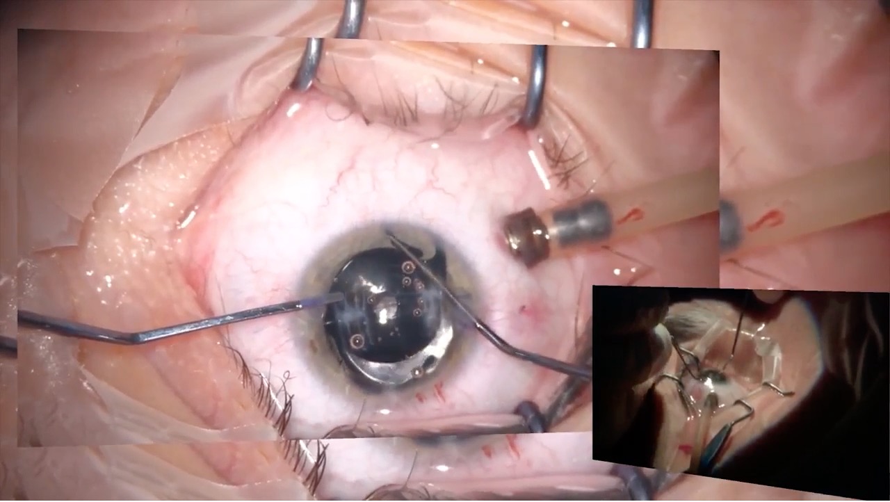 XtraFocus Pinhole Implant for Irregular Cornea and Fixated 3-Piece IOL