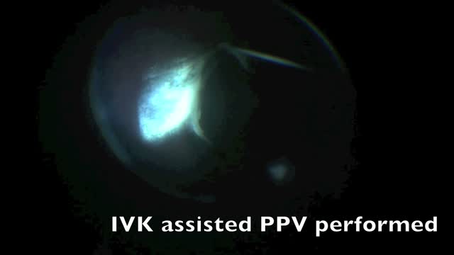 ILM Flap for Macular Hole Repair