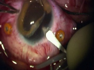 Traumatic Cataract, Iridodialysis, Retinal Detachment