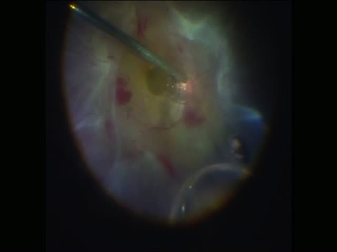 Combined Peeling and Segmentation for Combined Retinal Detachment