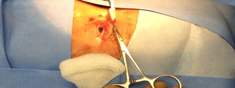 Chen's Modified Total Sutureless Fasanella-Servat Ptosis Repair