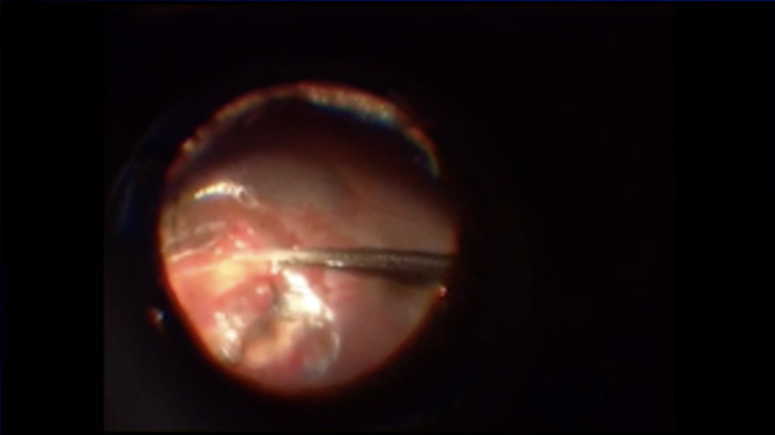 Bilateral Perforation