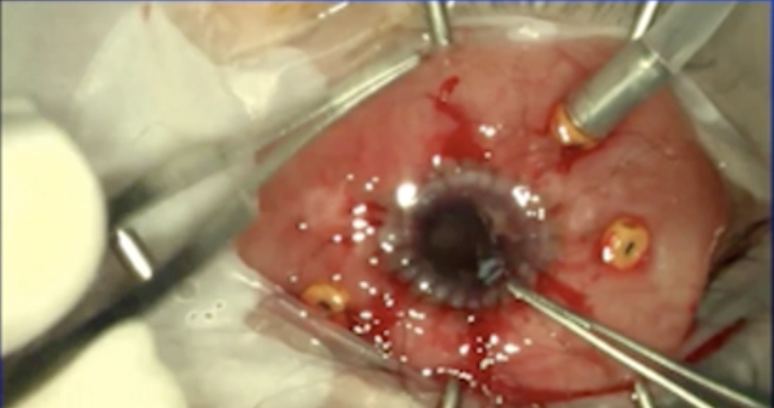 Silicone Retention Sutures