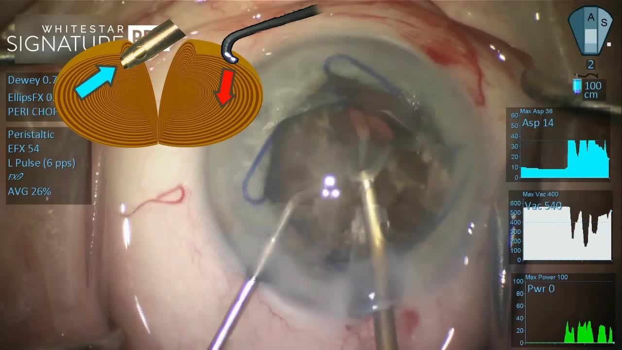 AMO Signature Pro with Horizontal Chop and a Dense Nucleus
