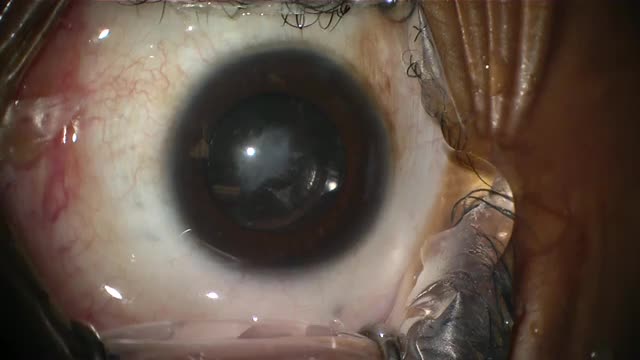 Anterior Capsule Phimosis in Myotonic Dystrophy