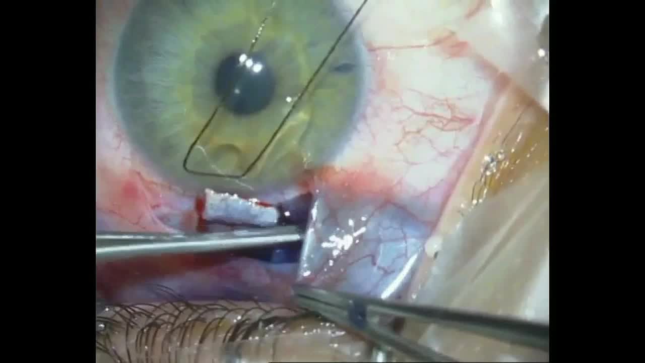 Vital Dye Assisted Glaucoma Procedures