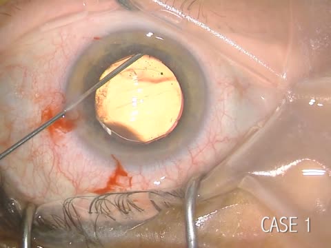 TriMoxiVanc Injections