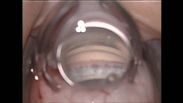 Get in on the ACT - Optimization of Angle Surgery