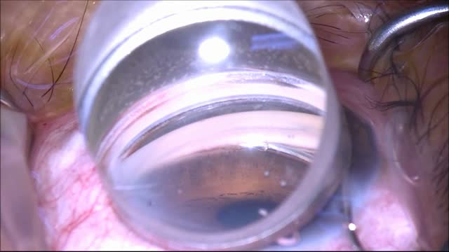 Hydrus Implantation