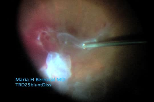 TRD 25g Lift & Peel Technique