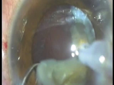 How to Tackle a Mature Cataract: Principles & Pearls!