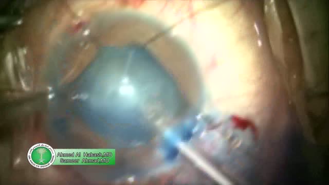 Tube Hooking During Phacoemulsification