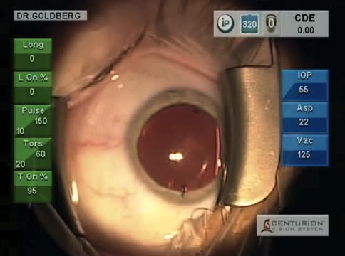 Centurion Vision System With AcrySof IQ Aspheric Toric IOL Implantation