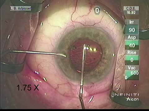 Dealing with Loose Zonules