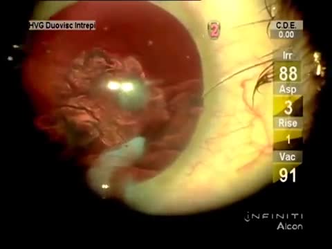 Posterior Polar Cataract