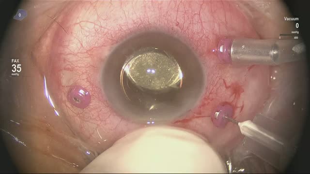 Using a 27 Gauge in MIVS at 7500 CPM