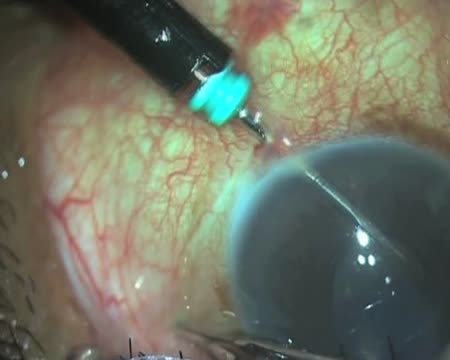 Trocar Anterior Chamber Maintainer (TACM)
