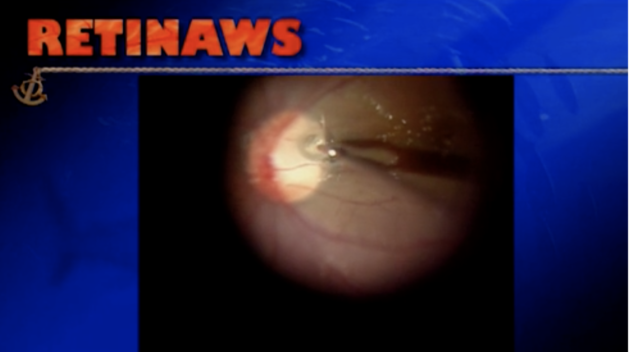 Optic Nerve Pit