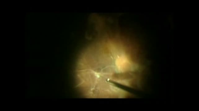 Illuminated Chopper for Phacoemulsification in PDR 