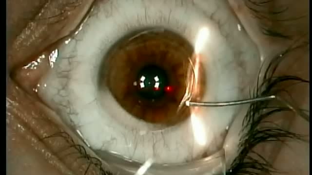 Disposable Instruments for Creating an Oval Flap