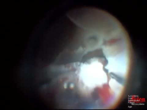 Surgical Treatment of VHL Retinal Angiomatosis
