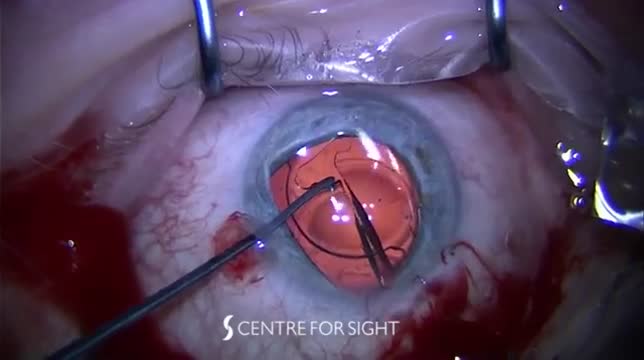 IOL Exchange for a Trifocal Lens Implant