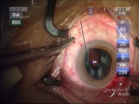Aniridia Ring-Bag-Lens Dislocation Repair